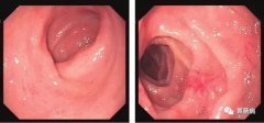 萎縮性胃炎不可怕，只要