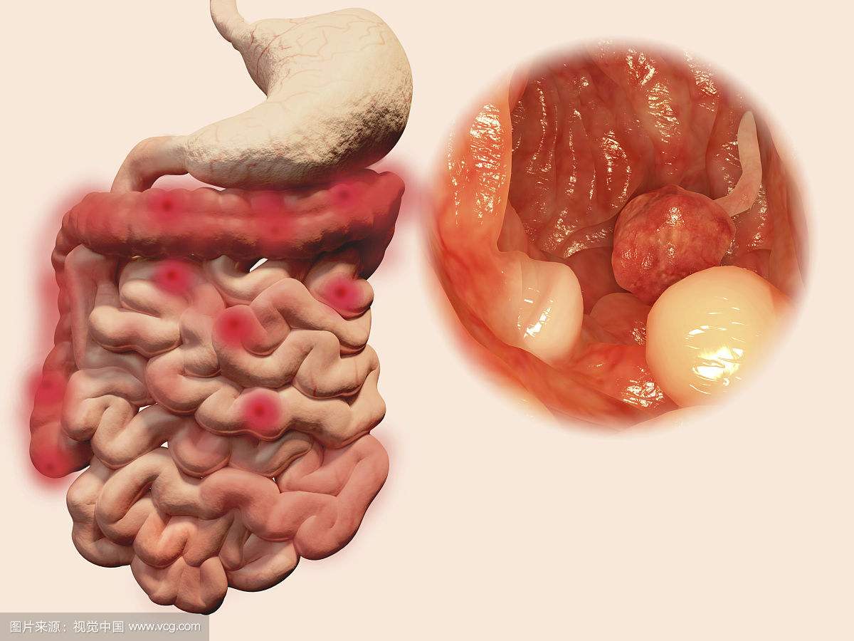 南寧直腸炎治療費(fèi)用是多少錢(qián)