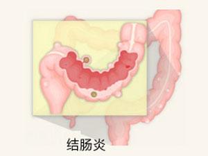 南寧治療結(jié)腸炎哪家醫(yī)院好