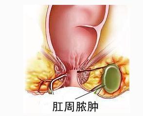 南寧哪個醫(yī)院治療肛周膿腫好