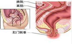 南寧治療脫肛哪家醫(yī)院好？南寧脫肛治療多少錢？